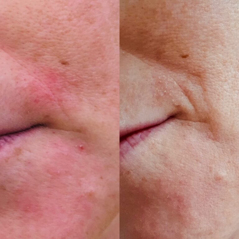 Periorale Dermatitis: 5 Tipps wie Du die Mundrose besiegst! | kosmedik
