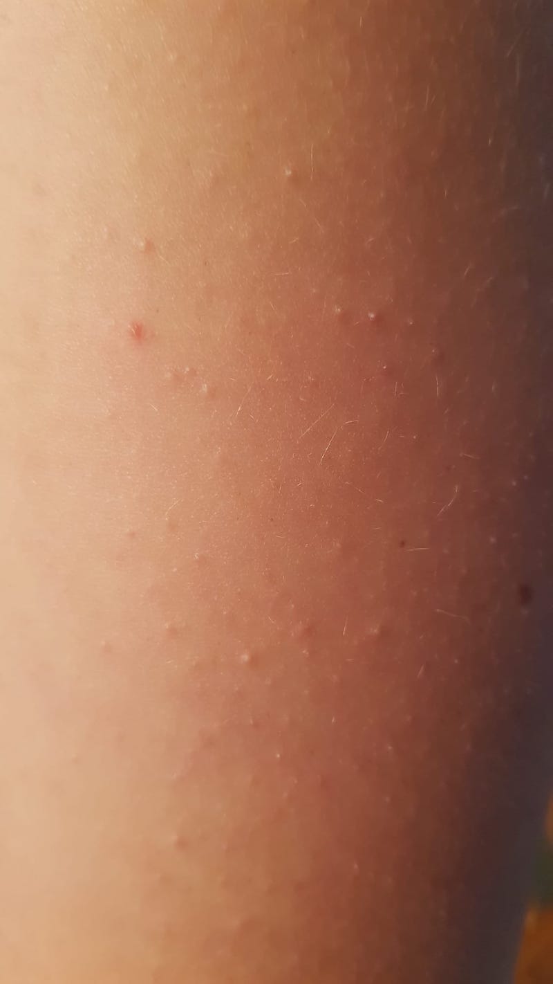 Reibeisenhaut behandeln – alles was Du über Keratosis Pilaris wissen ...