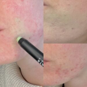 Vorher und nacher Rötungen kaschiert mit grünem Concealer