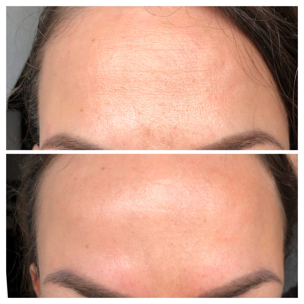 Mesoéclat VIP Anti-Aging-Behandlung 2 Mesoeclat behandlung